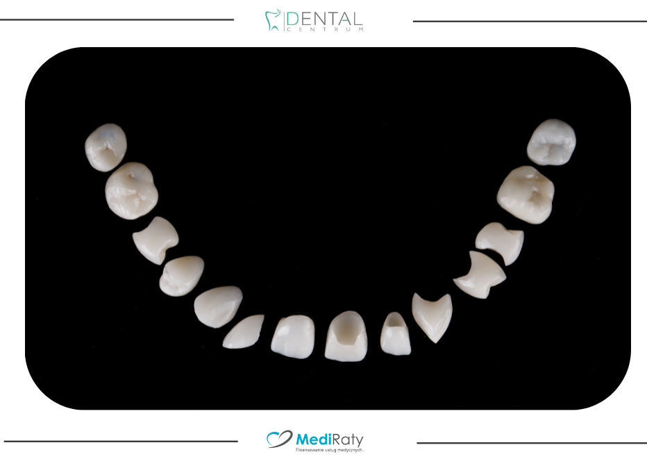 Estetyczna odbudowa uzębienia – jakie „sztuczne zęby” wybrać?