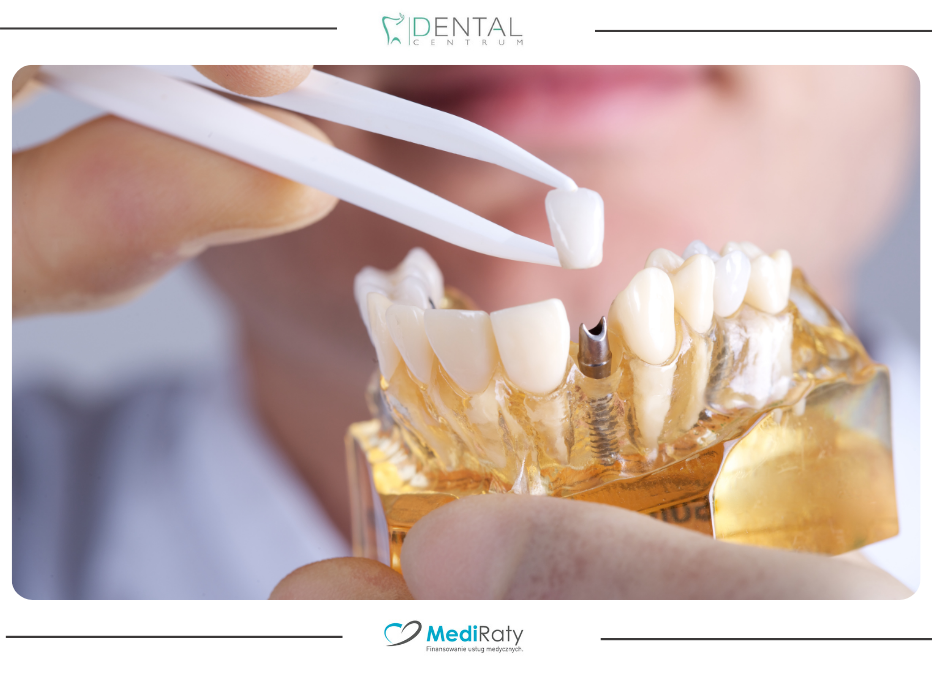 Implanty zębów w narkozie – nowe zęby po 1 wizycie!
