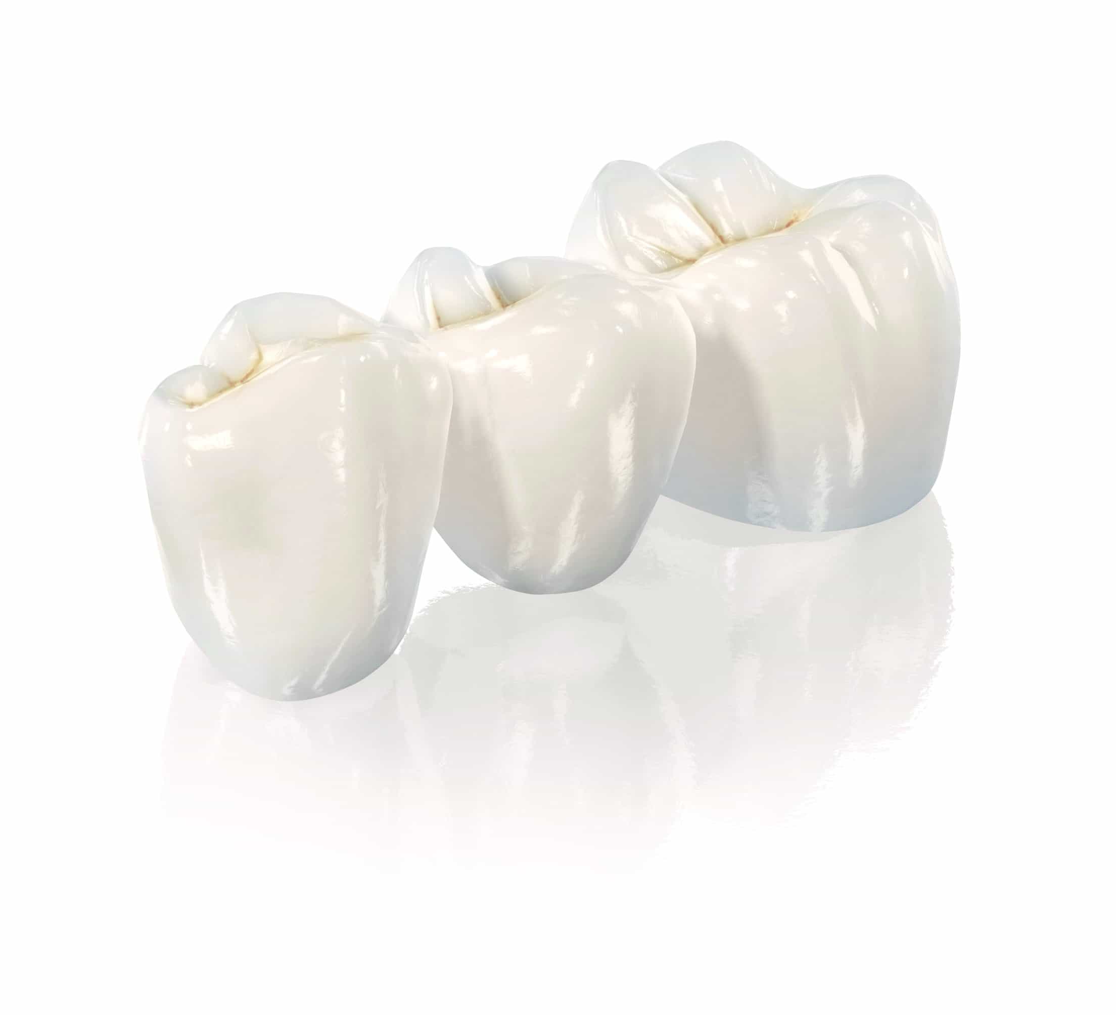 Porcelain bridge on the patient's own teeth