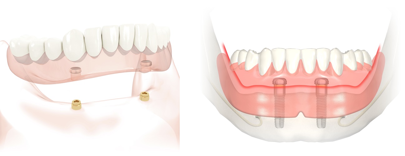 Proteza na implantach