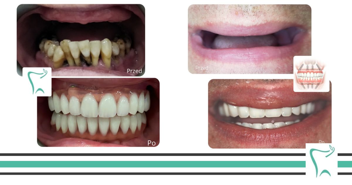 All-on-4: rekonstrukcja utraconych zębów w jeden dzień