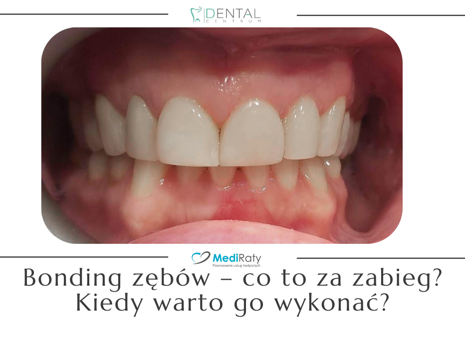 Bonding zębów – co to za zabieg? Kiedy warto go wykonać? | dentalcentrum.pl