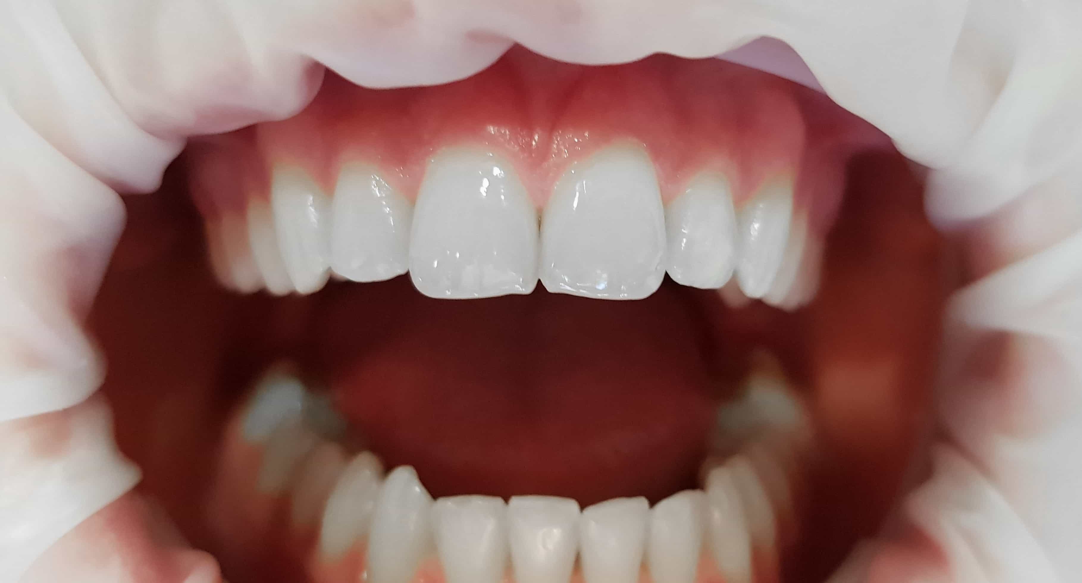 Bonding – estetyczna pomoc w błyskawicznej korekcie kształtu i koloru zębów