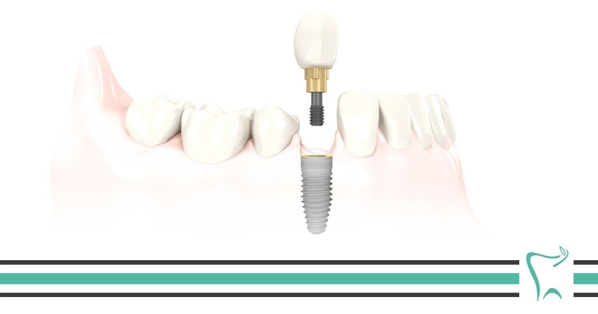 Implant zęba Implant zęba