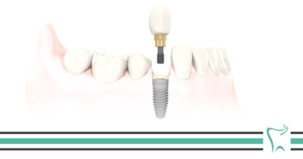 Implant zęba