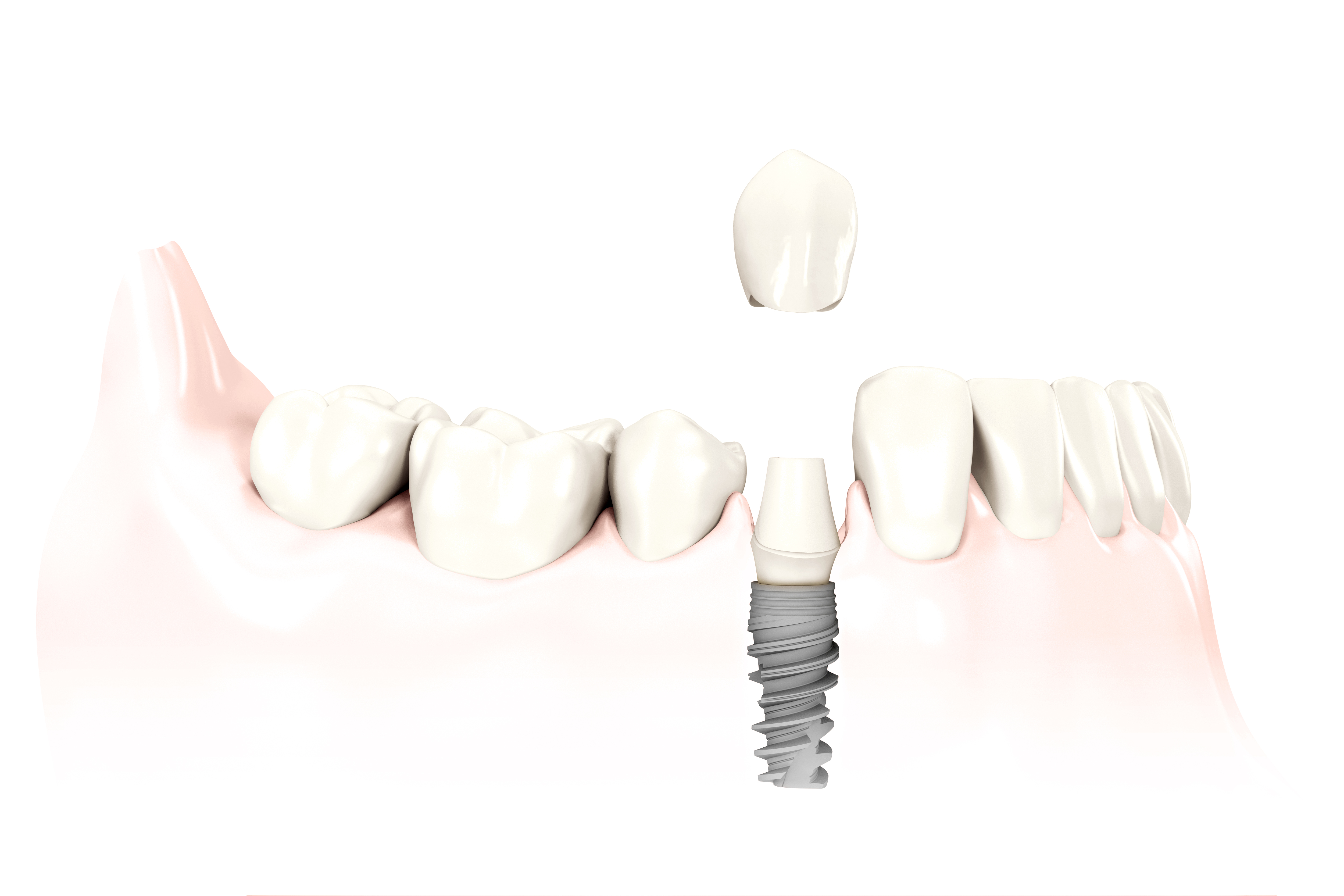 IMPLANT ZĘBOWY
