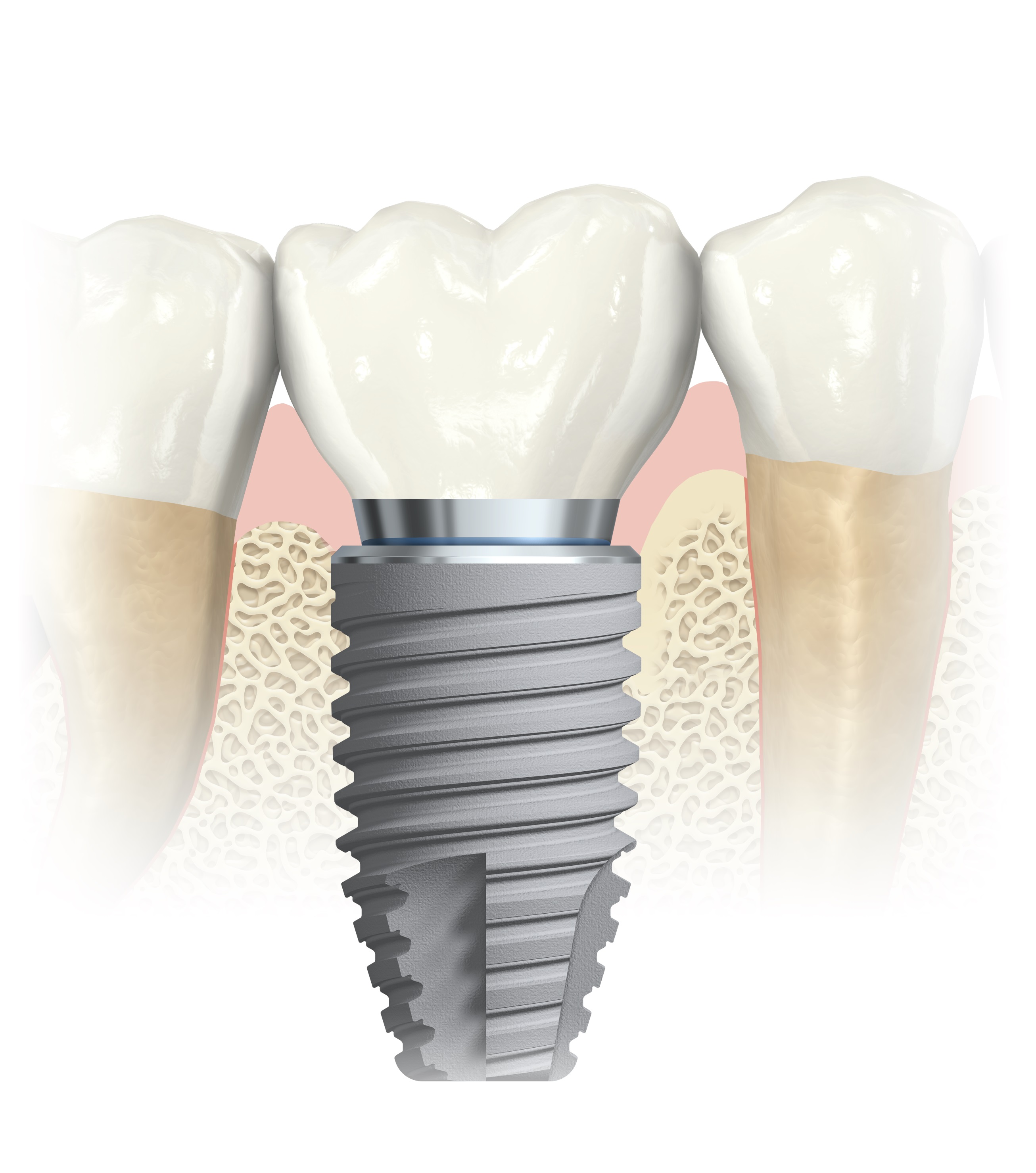 IMPLANT ZĘBOWY