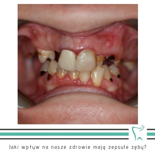 Jaki wpływ na nasze zdrowie mają zepsute zęby