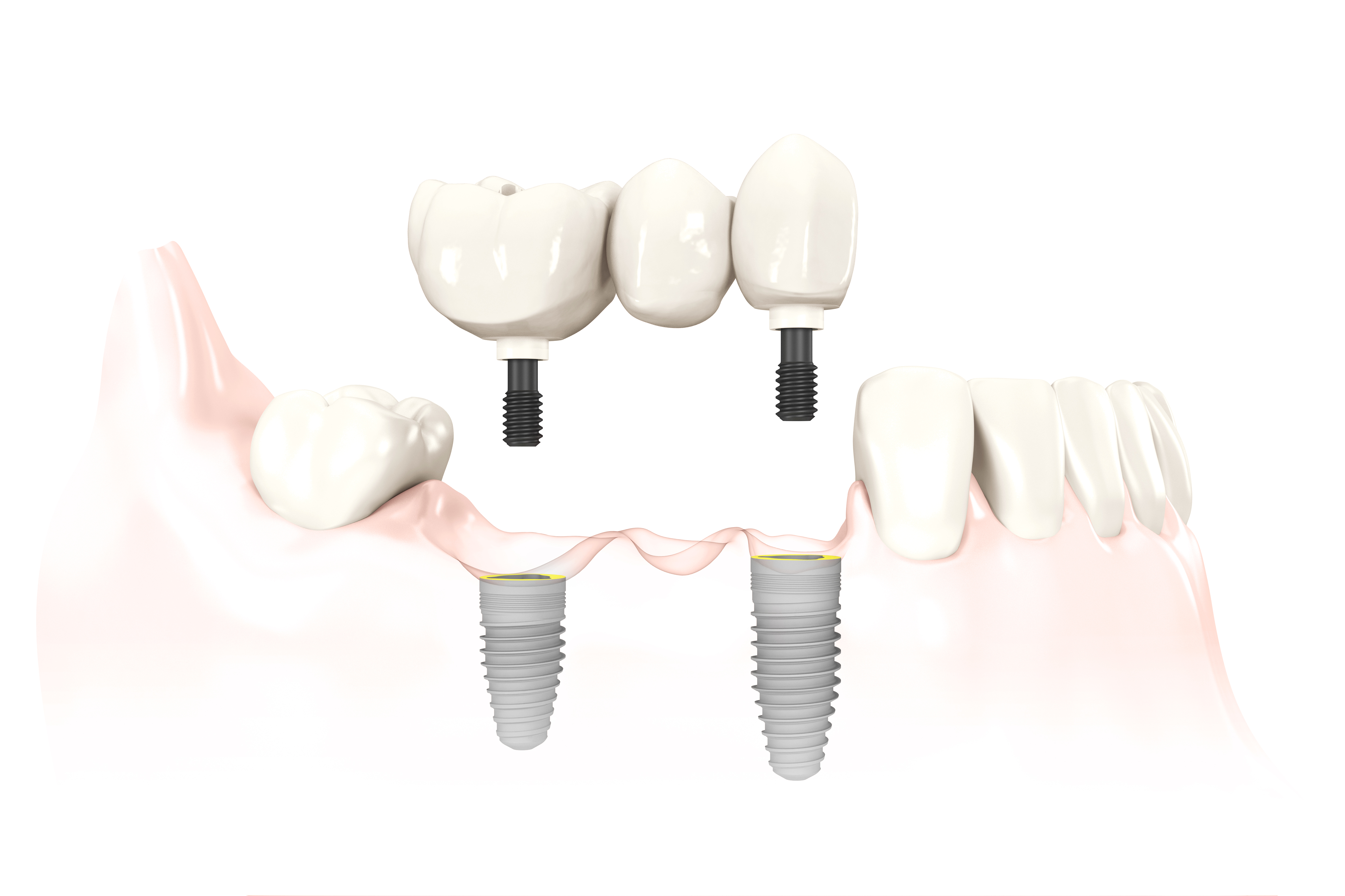 Porcelain bridge on implants