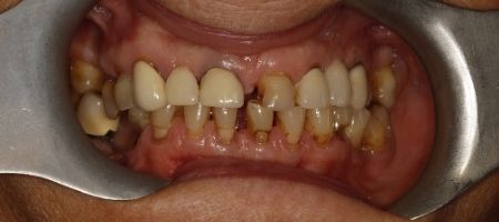 Odbudowa protetyczna szczęki górnej i dolnej koronami porcelanowymi na zębach własnych