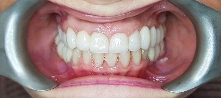 Odbudowa protetyczna szczęki górnej i dolnej koronami porcelanowymi na zębach własnych