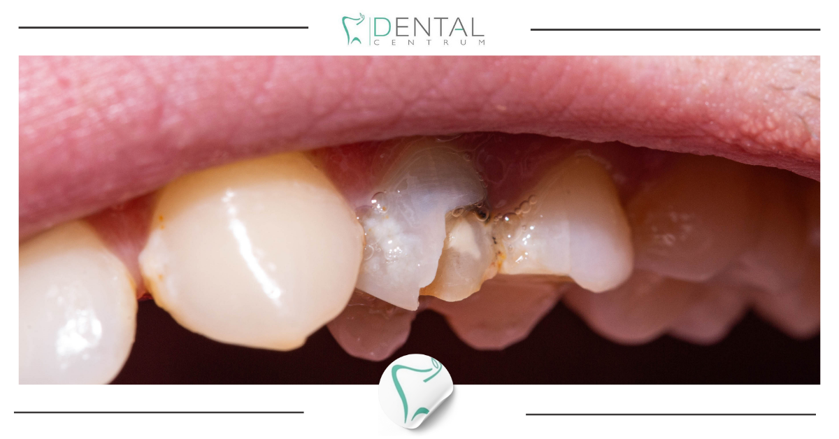 Pęknięcie wewnętrzne zęba: jak je rozpoznać? Pęknięcie wewnętrzne zęba: jak je rozpoznać?