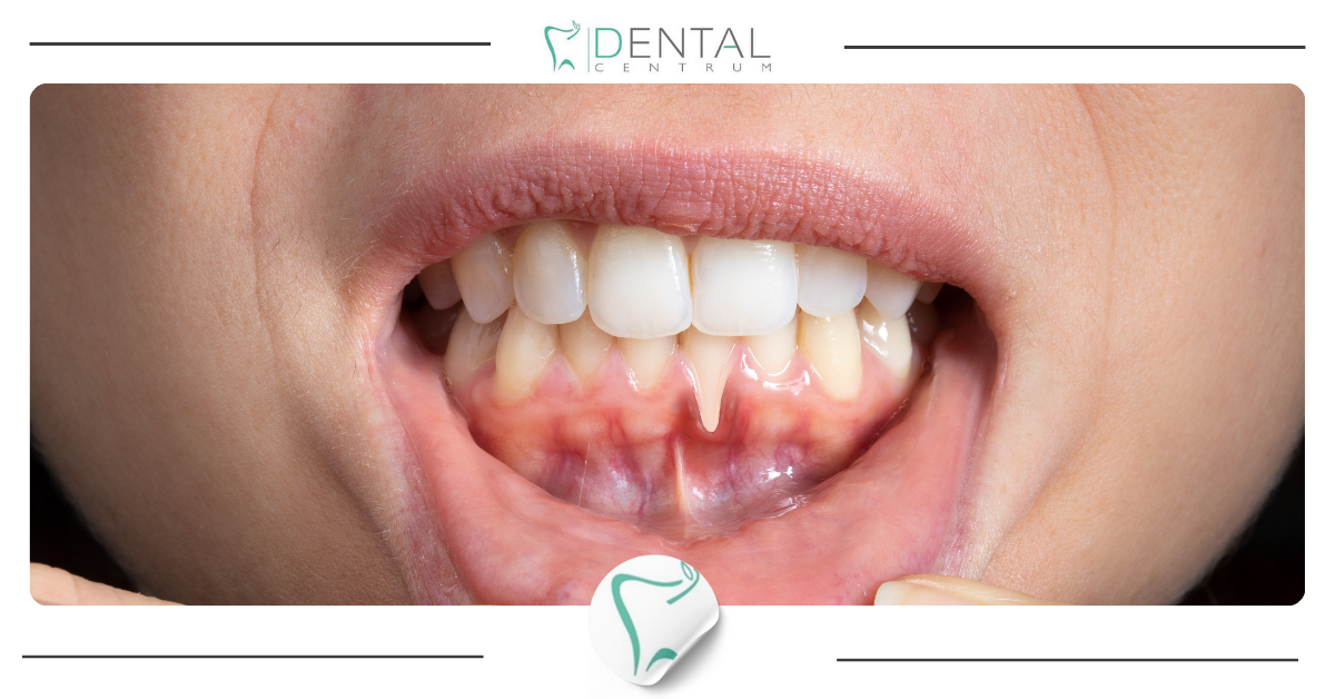 Paradontoza: objawy i leczenie Paradontoza: objawy i leczenie