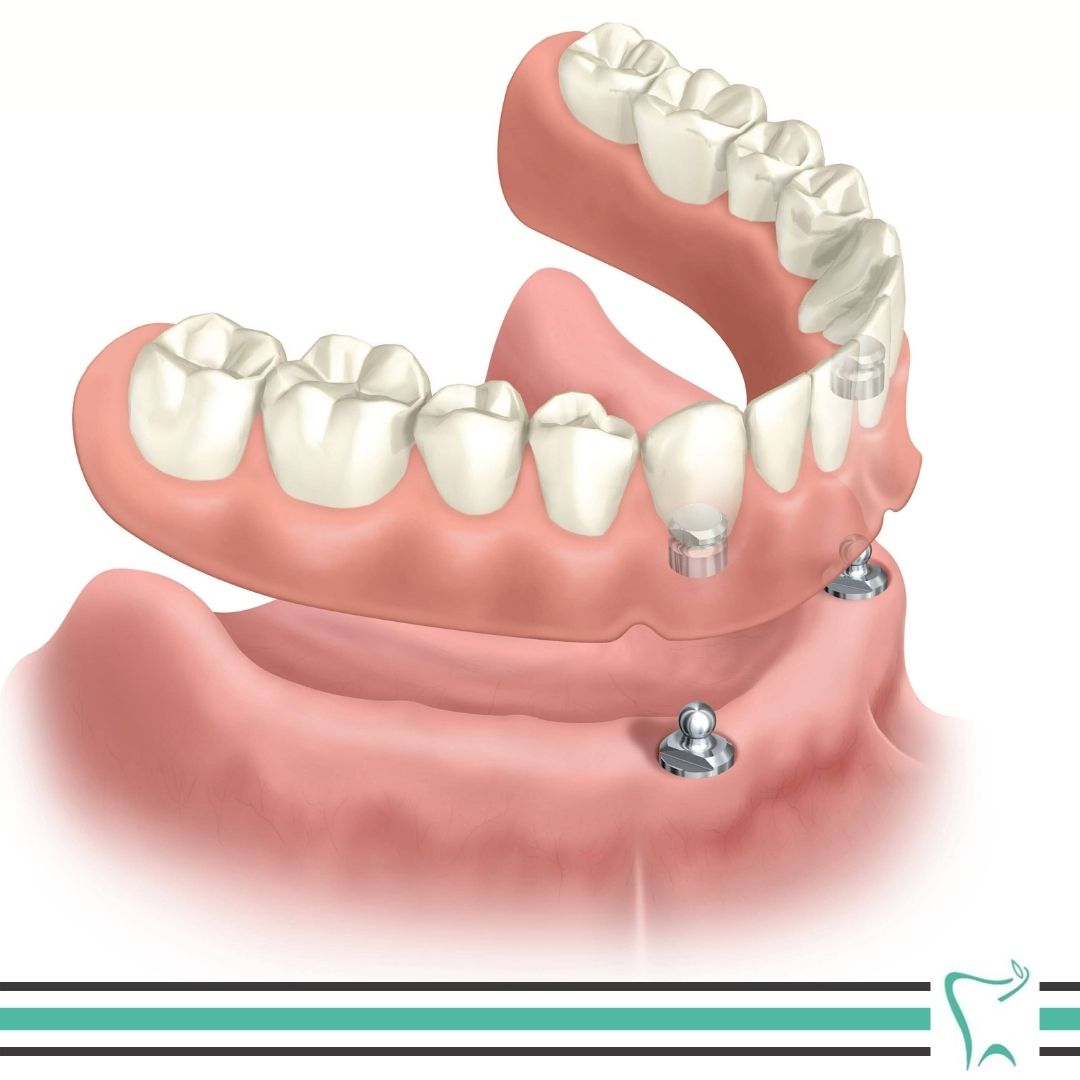 Proteza zębowa mocowana na 2 implantach Proteza zębowa mocowana na 2 implantach