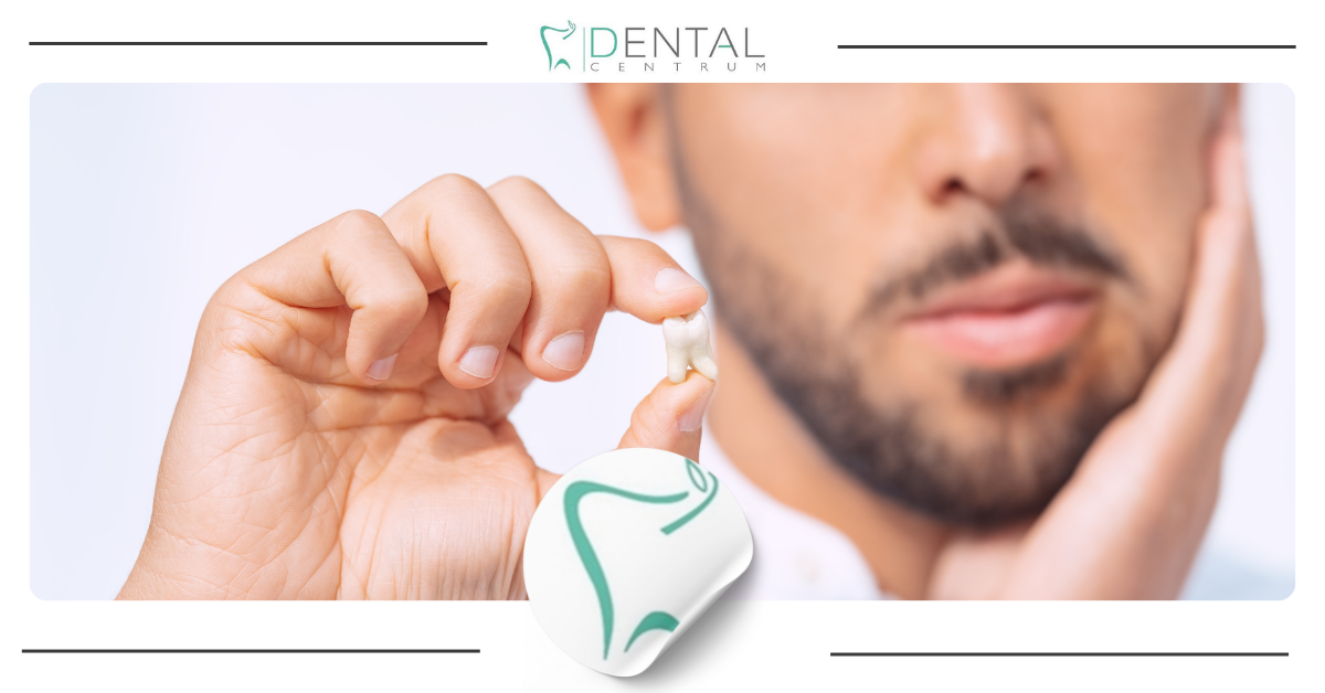 Rekonwalescencja po ekstrakcji zęba Rekonwalescencja po ekstrakcji zęba