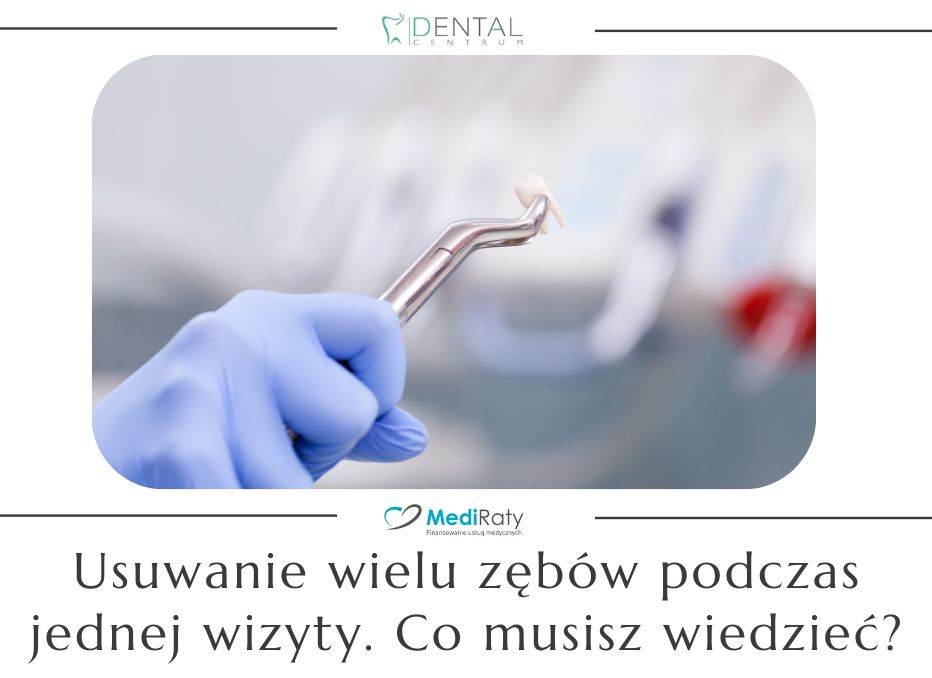 Usuwanie wielu zębów podczas jednej wizyty. Co musisz wiedzieć