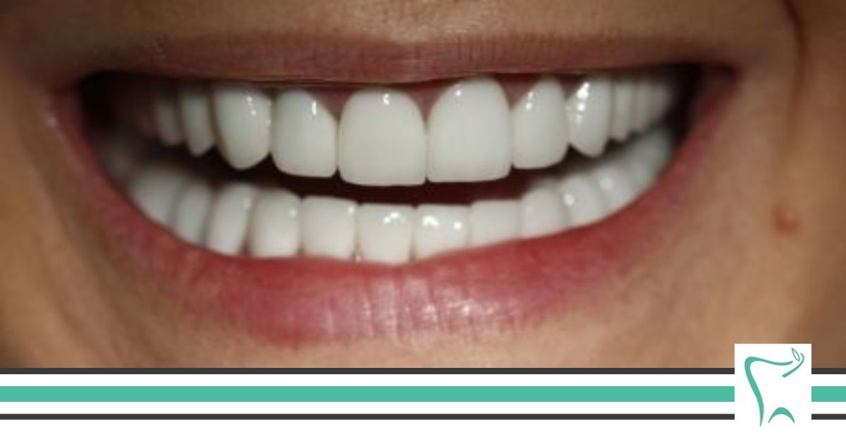 Uzupełnienia brakujących zębów: mosty porcelanowe