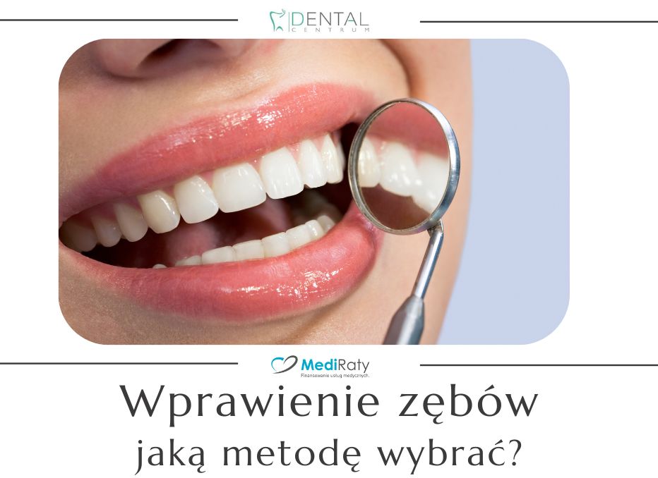 Wprawienie zębów – jaką metodę wybrać