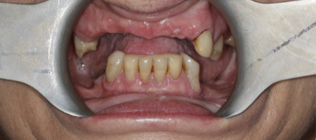 zęby górne i dolne do usunięcia
