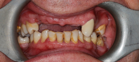 zęby górne do usunięcia
