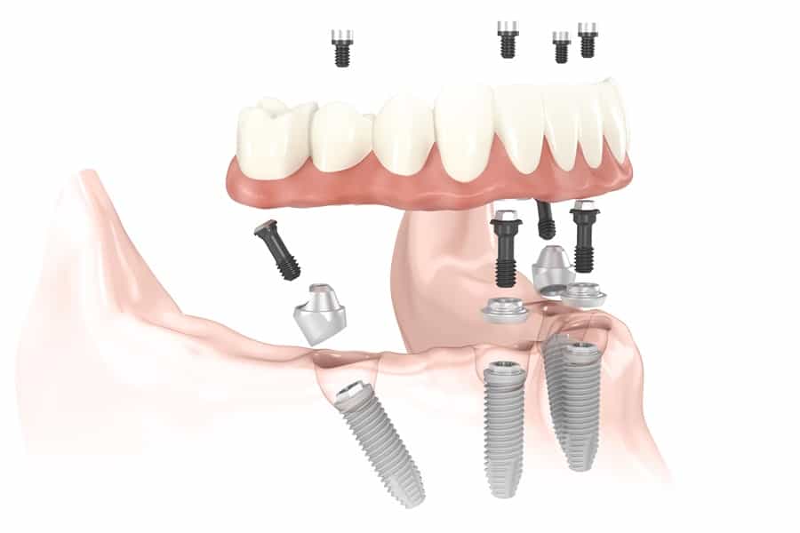 All-on-four Odbudowa zębów na 4 implantach