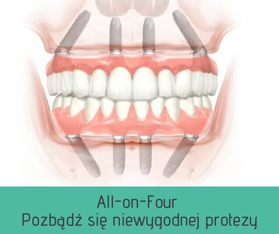 Nowe zęby na 4 implantach - system all-on-Four