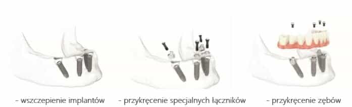 Etapy odbudowy zębów All-on-four na implantach