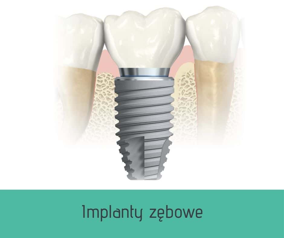 Implant zębowy