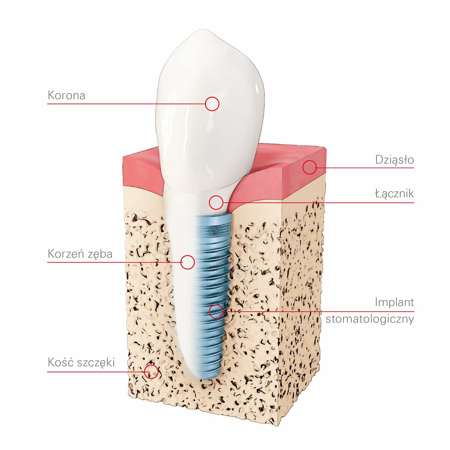Implant zęba Implant zębowy