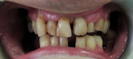 Zęby przed leczeniem