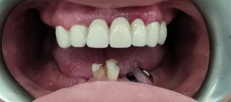 Zęby przed leczeniem
