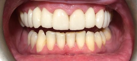 Zęby po leczeniu