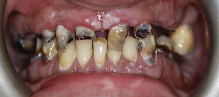 Zęby przed leczeniem i szlifowaniem