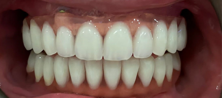 Zęby po leczeniu