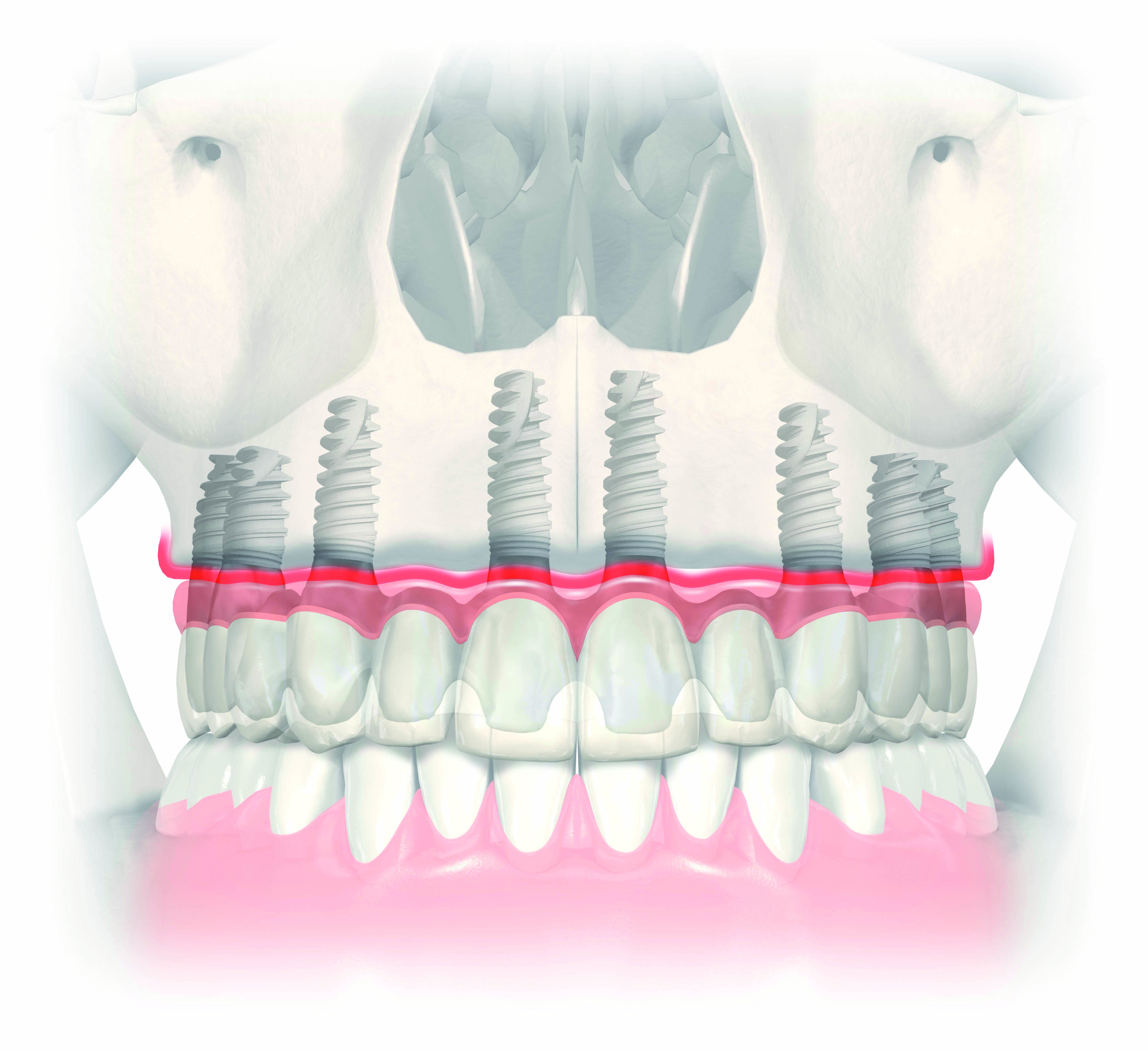 Permanent tooth reconstruction with a porcelain bridge on five or more implants