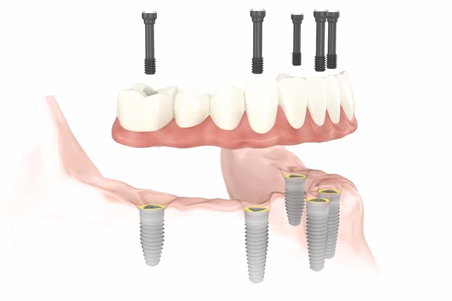 Most porcelanowy na stałe na czterech implantach Most porcelanowy na stałe na czterech implantach