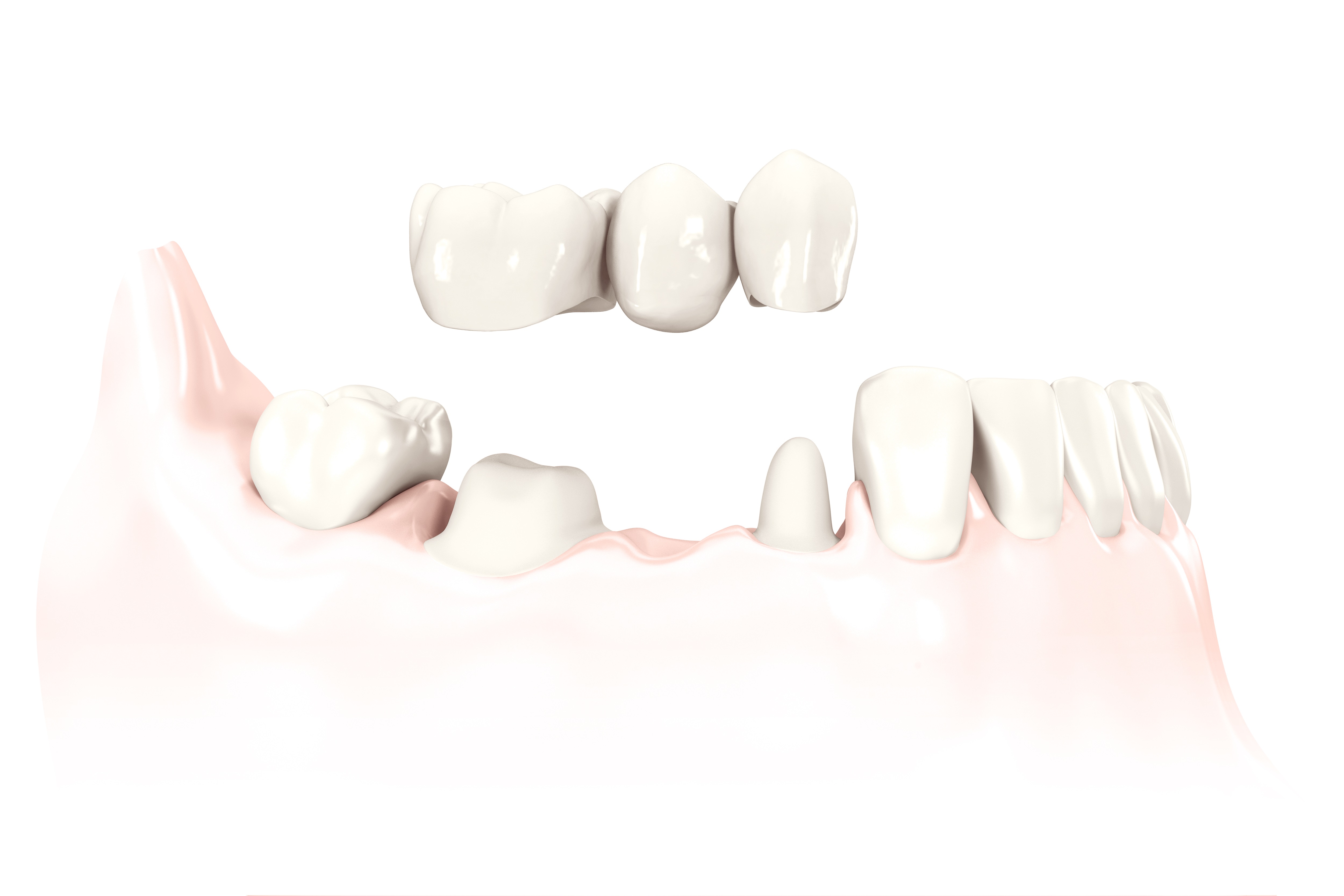Porcelain bridge on the patient's own teeth