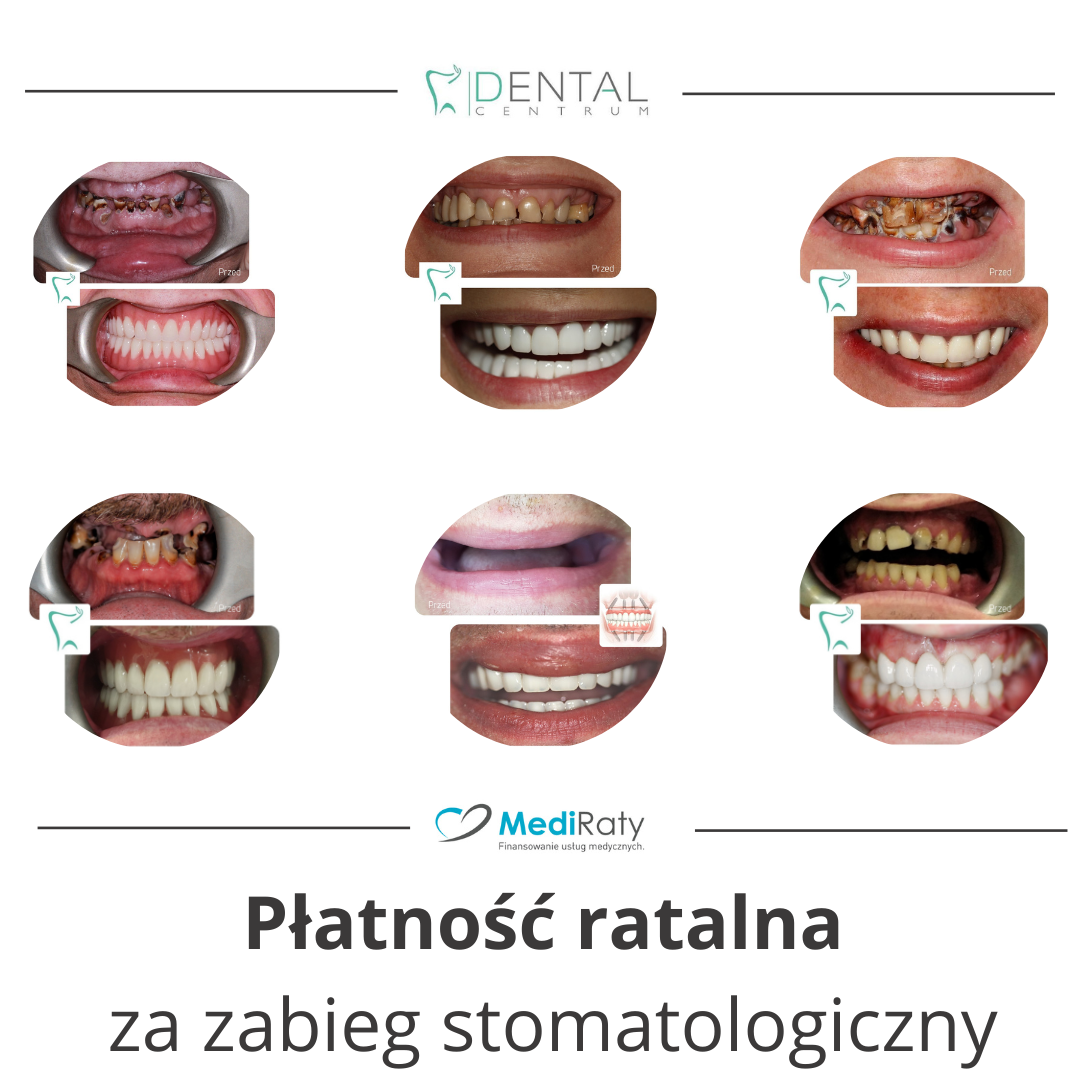 Płatność ratalna na leczenie stomatologiczne