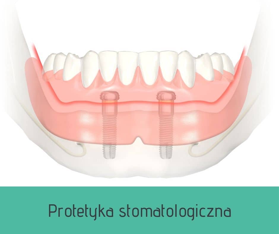 Protetyka stomatologiczna