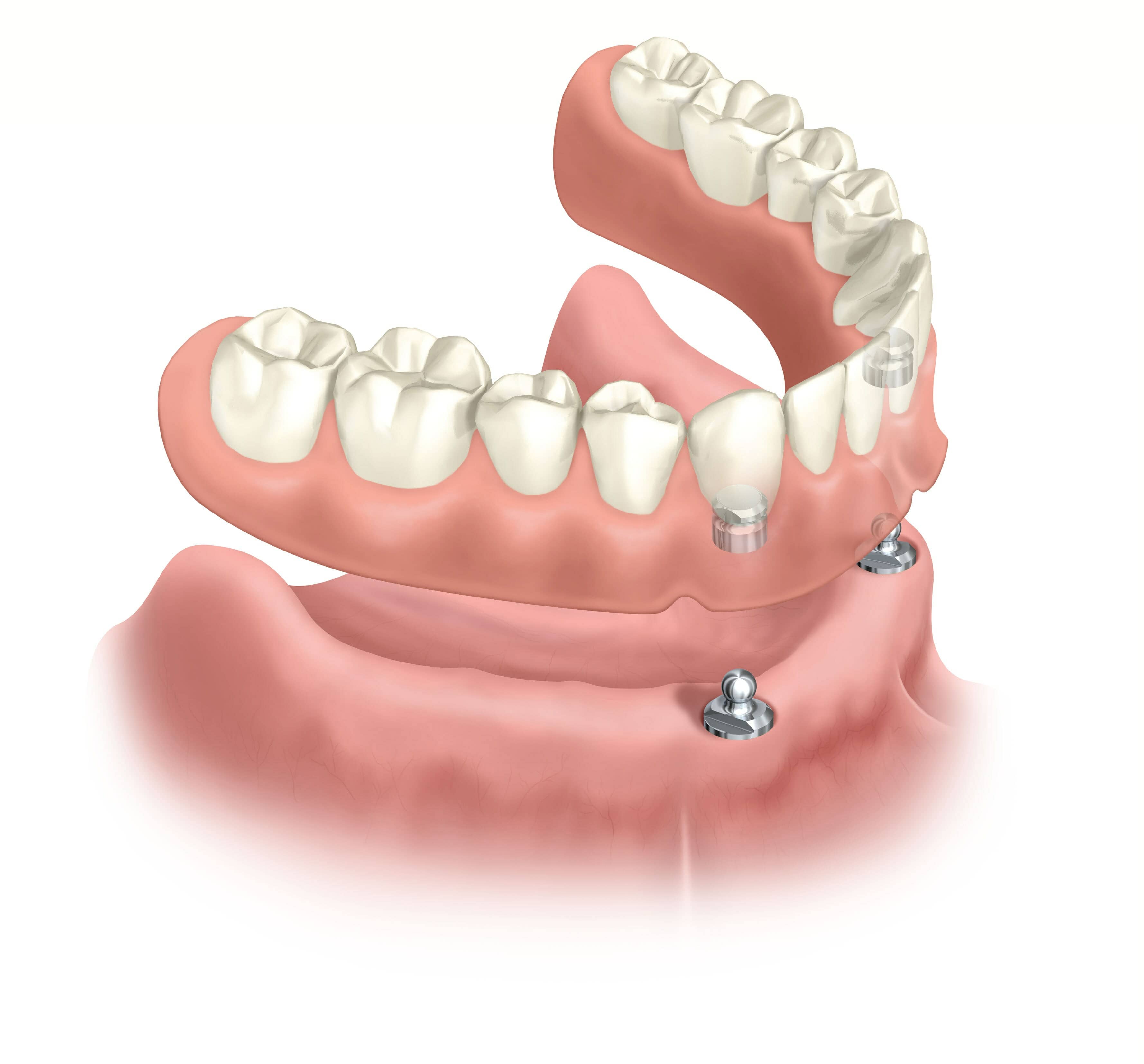 Removable acrylic lower denture mounted on two implants - Locator®System