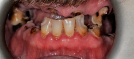 zęby górne i dolne do usunięcia