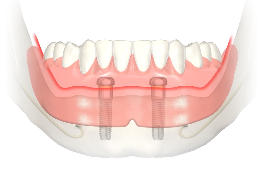Proteza zębowa mocowana na dwóch implantach