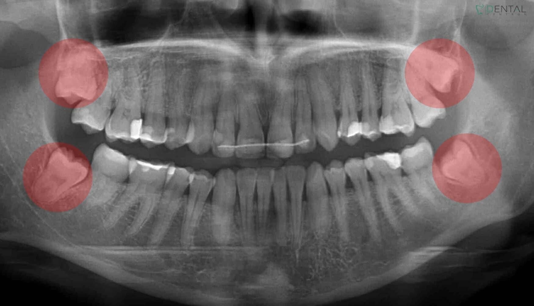 Removal of teeth under anaesthesia