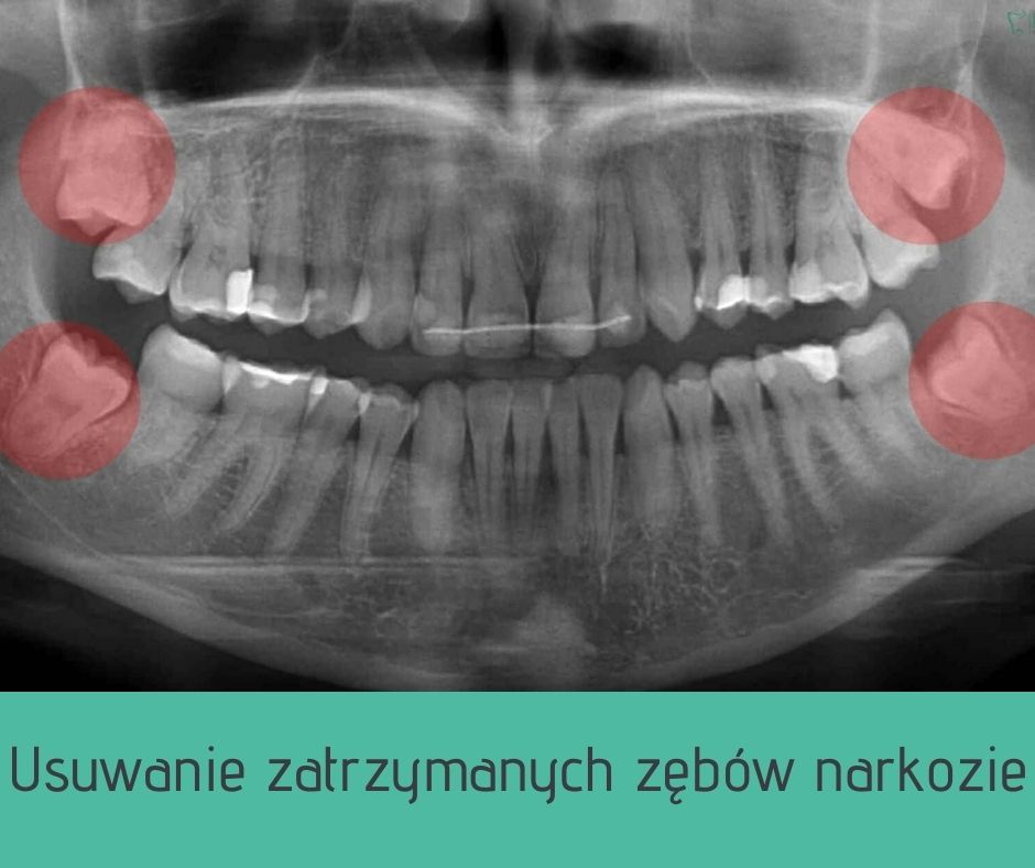 Usuwanie zębów pod narkozą