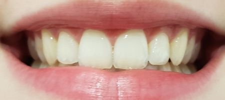 wybielanie zębów w gabinecie stomatologicznym