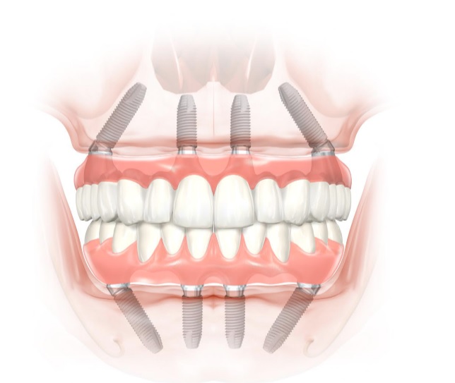 All-on-Four® - permanent restoration of teeth on four implants