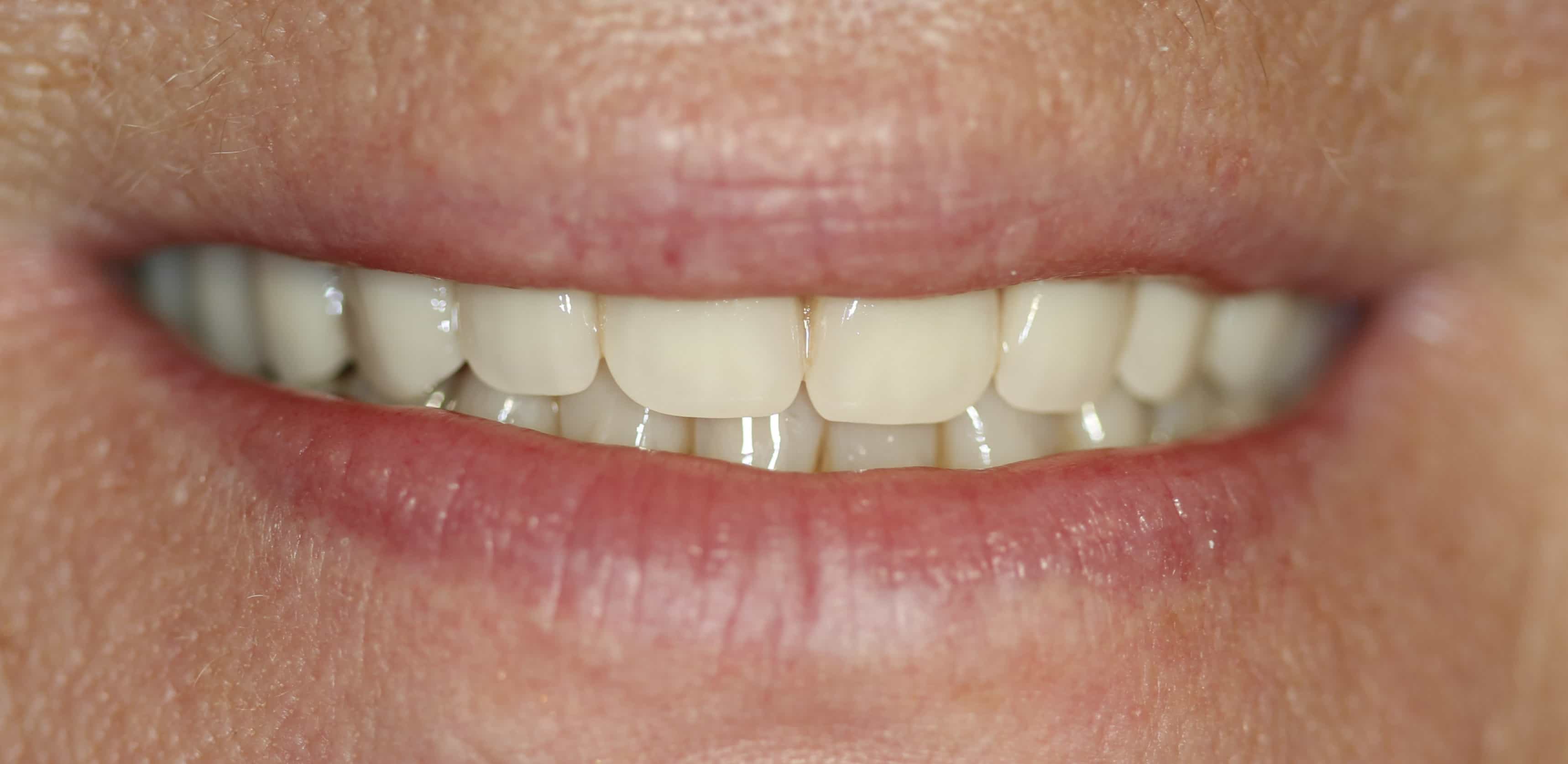Zamknięcie szpar (przerw) między zębami w szczęce dolnej