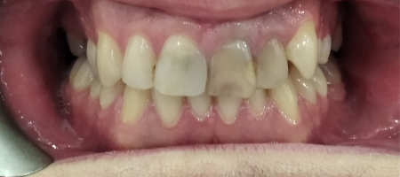 Zęby przed leczeniem i szlifowaniem
