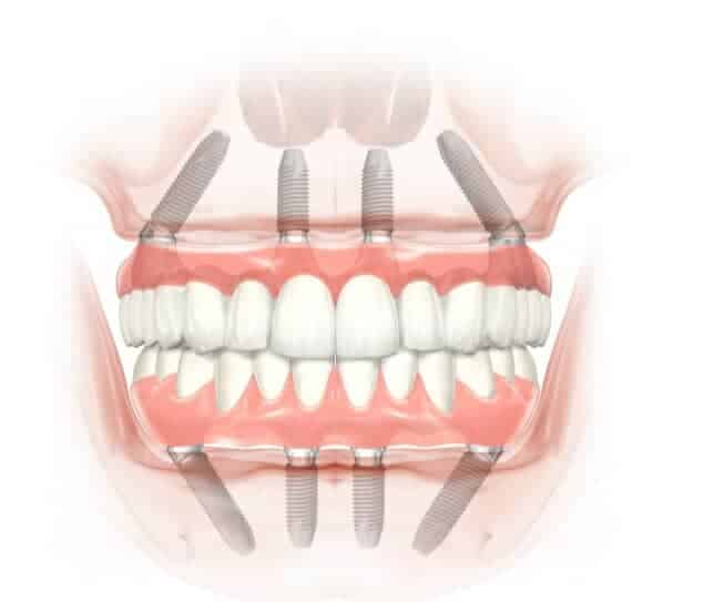 ZĘBY NA 4 IMPLANTACH - ALL ON 4