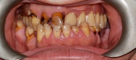 Zepsute zęby przed metamorfozą
